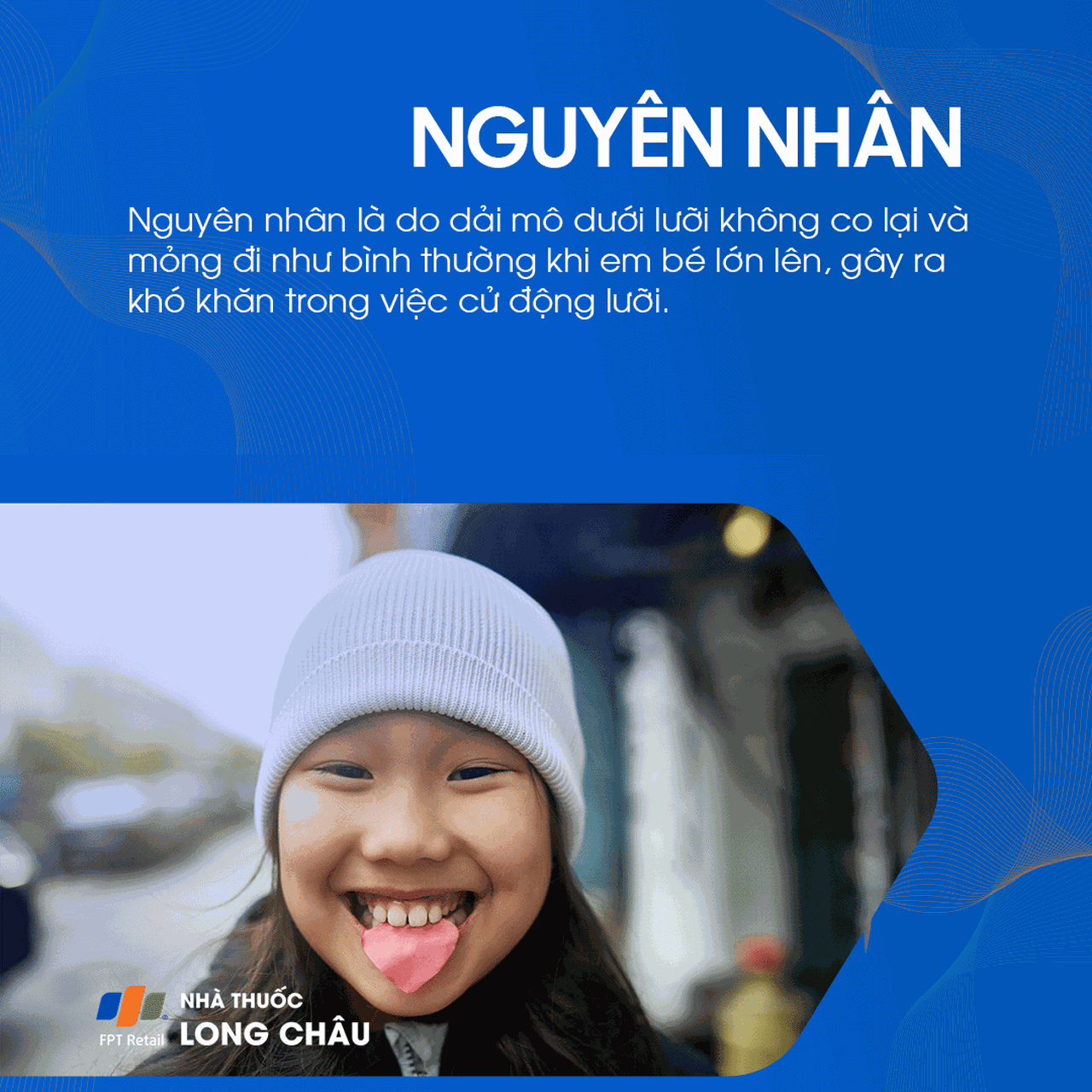 Dính thắng lưỡi 3