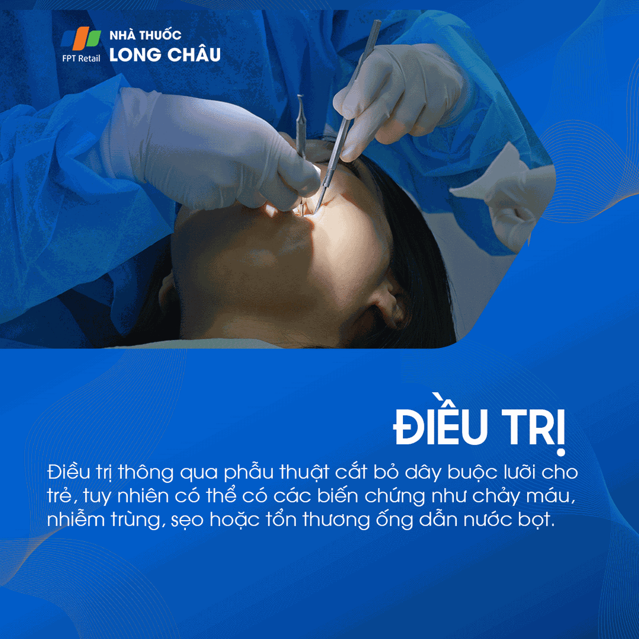 Dính thắng lưỡi 6