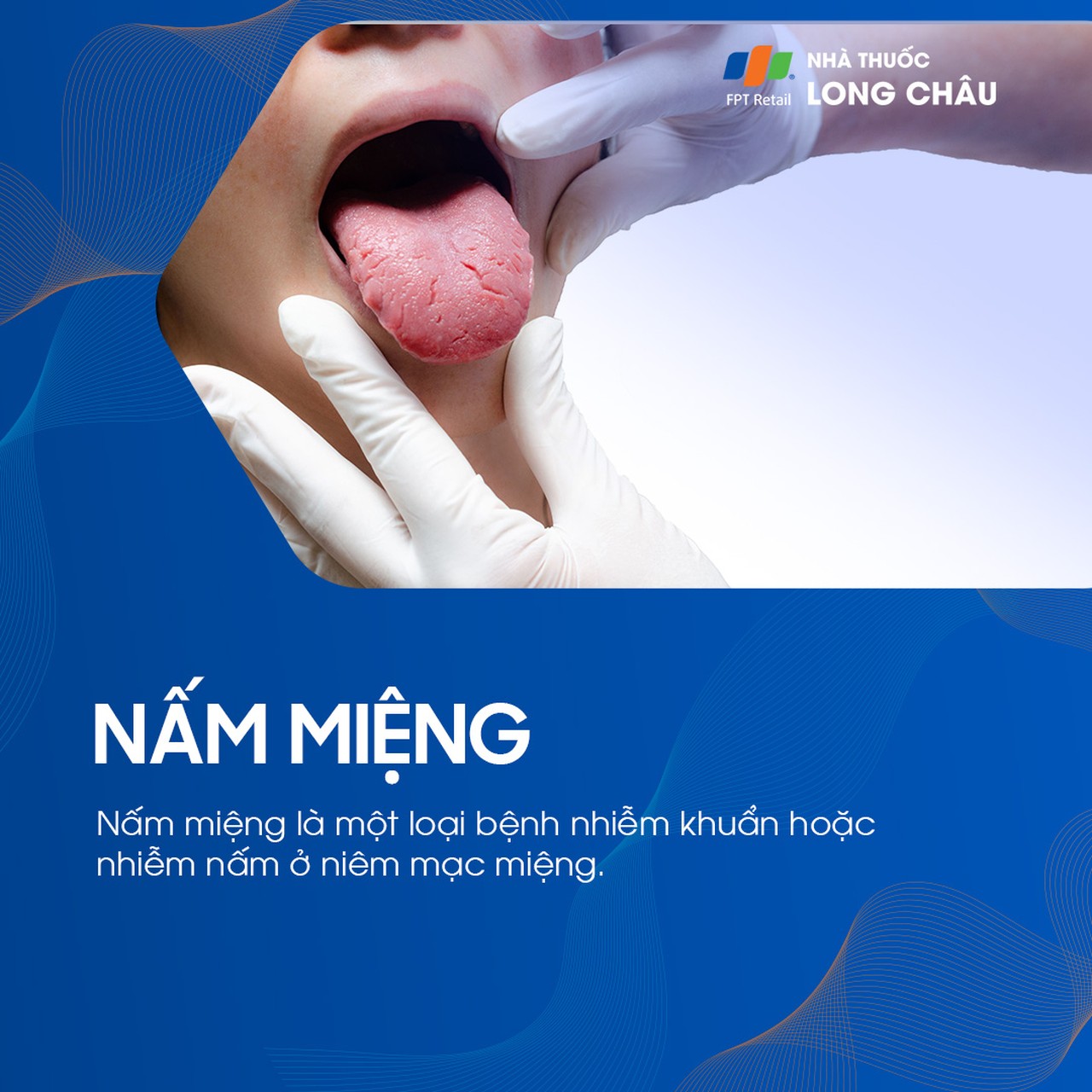 Nấm miệng 1