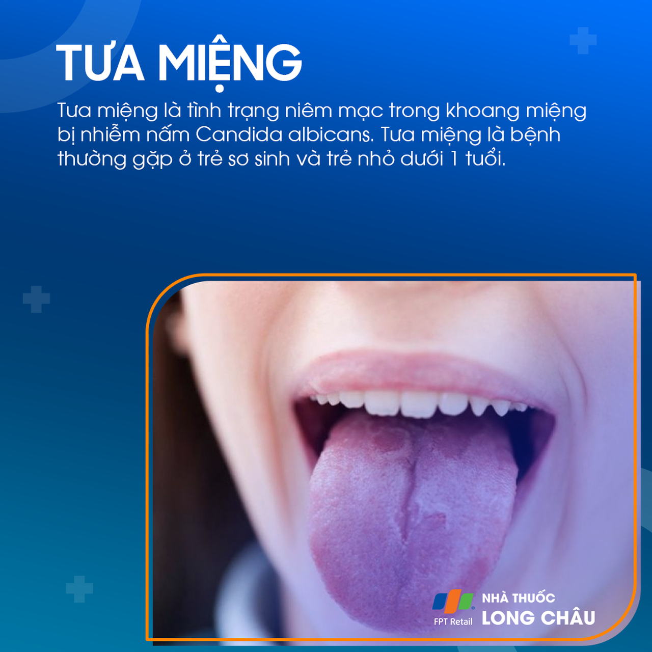 Tưa miệng 1