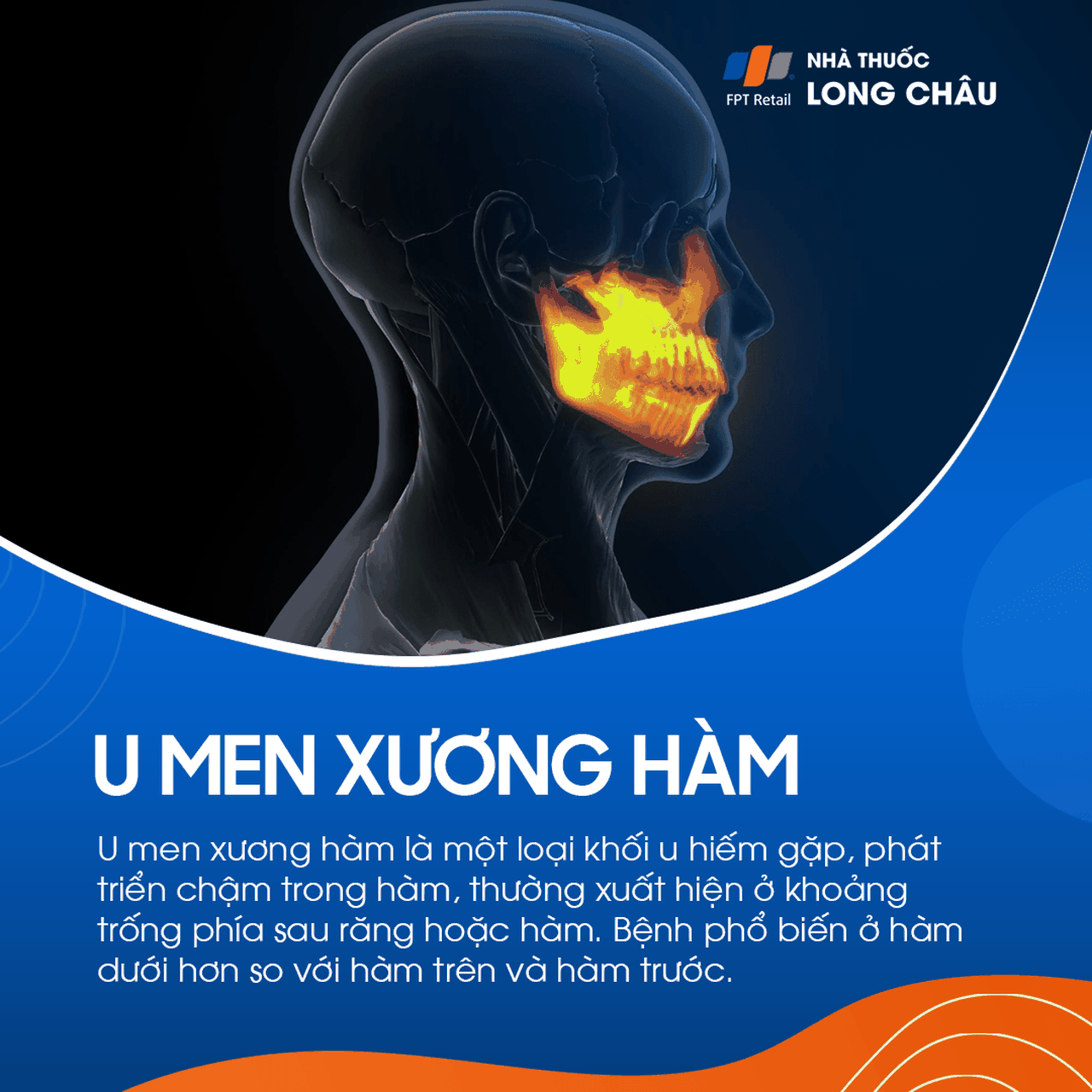 U men xương hàm 1