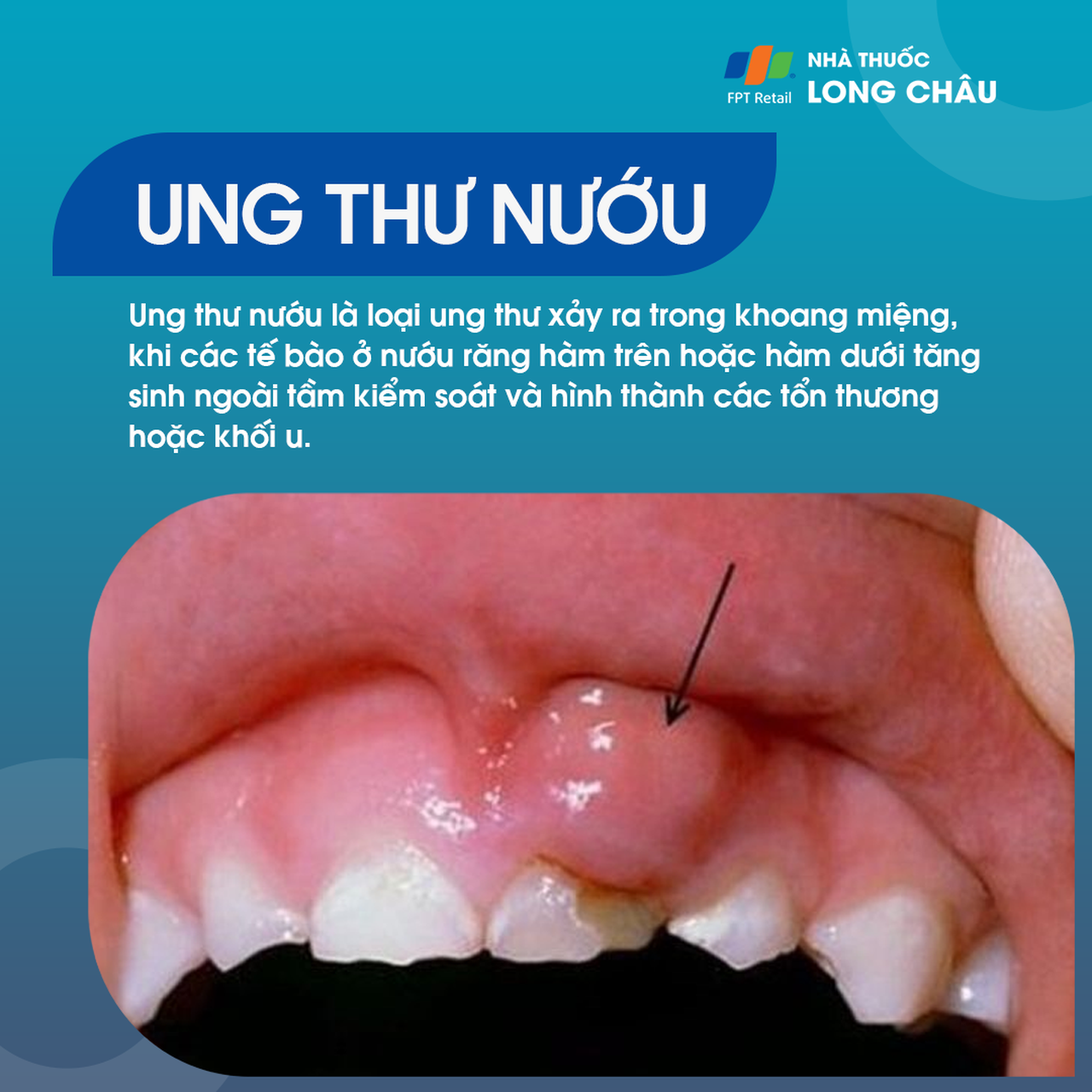 Ung thư nướu răng 1