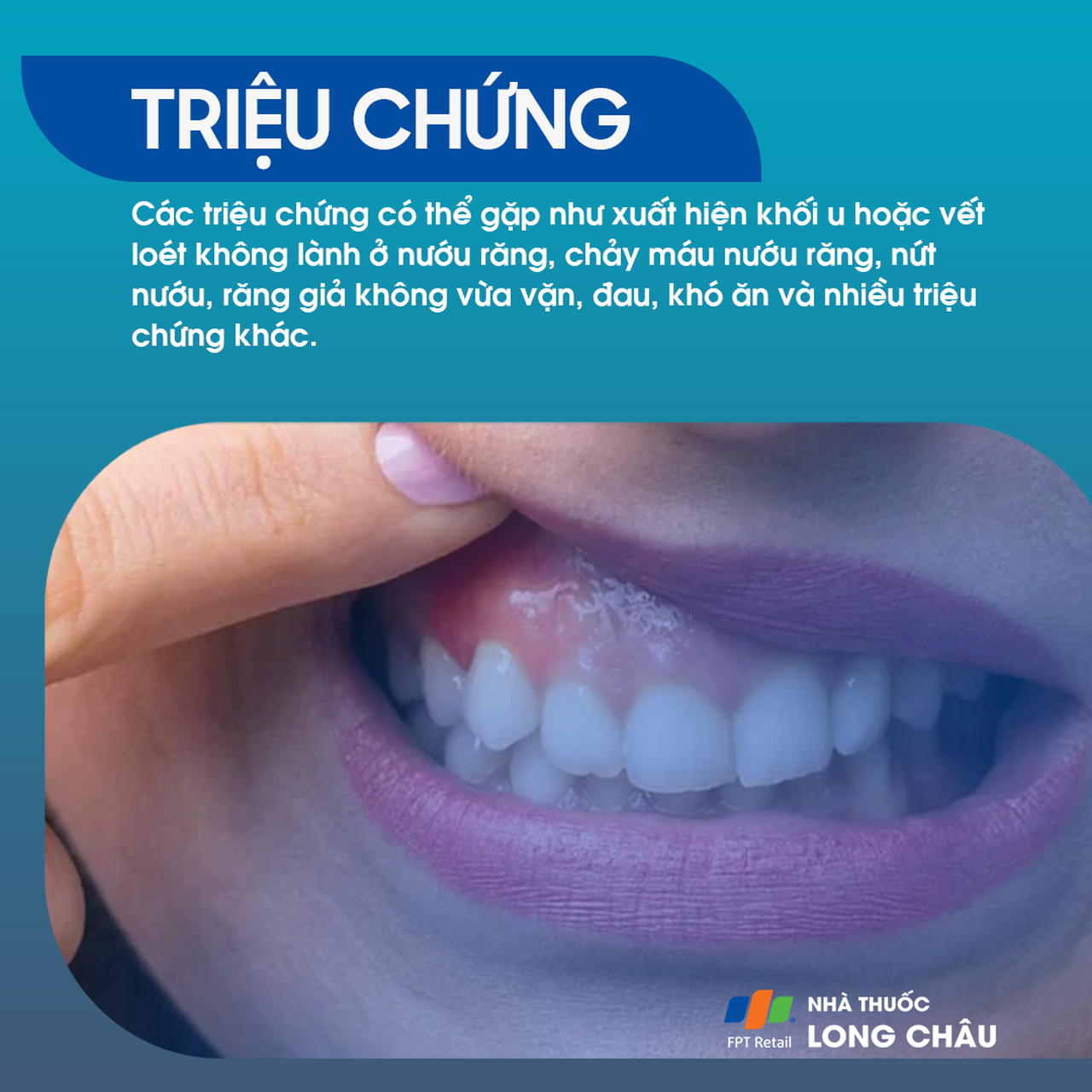 Ung thư nướu răng 2