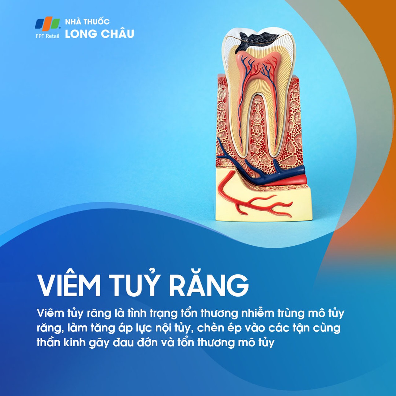 Viêm tủy răng 1