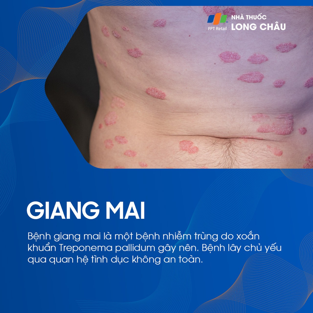 Biểu hiện ngoài da của bệnh giang mai giai