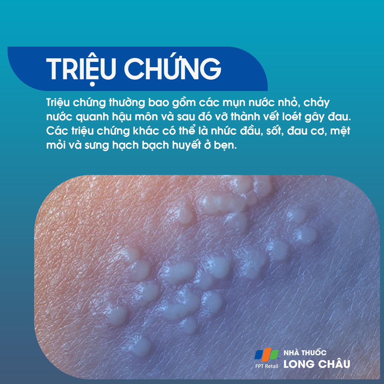 Herpes hậu môn 2