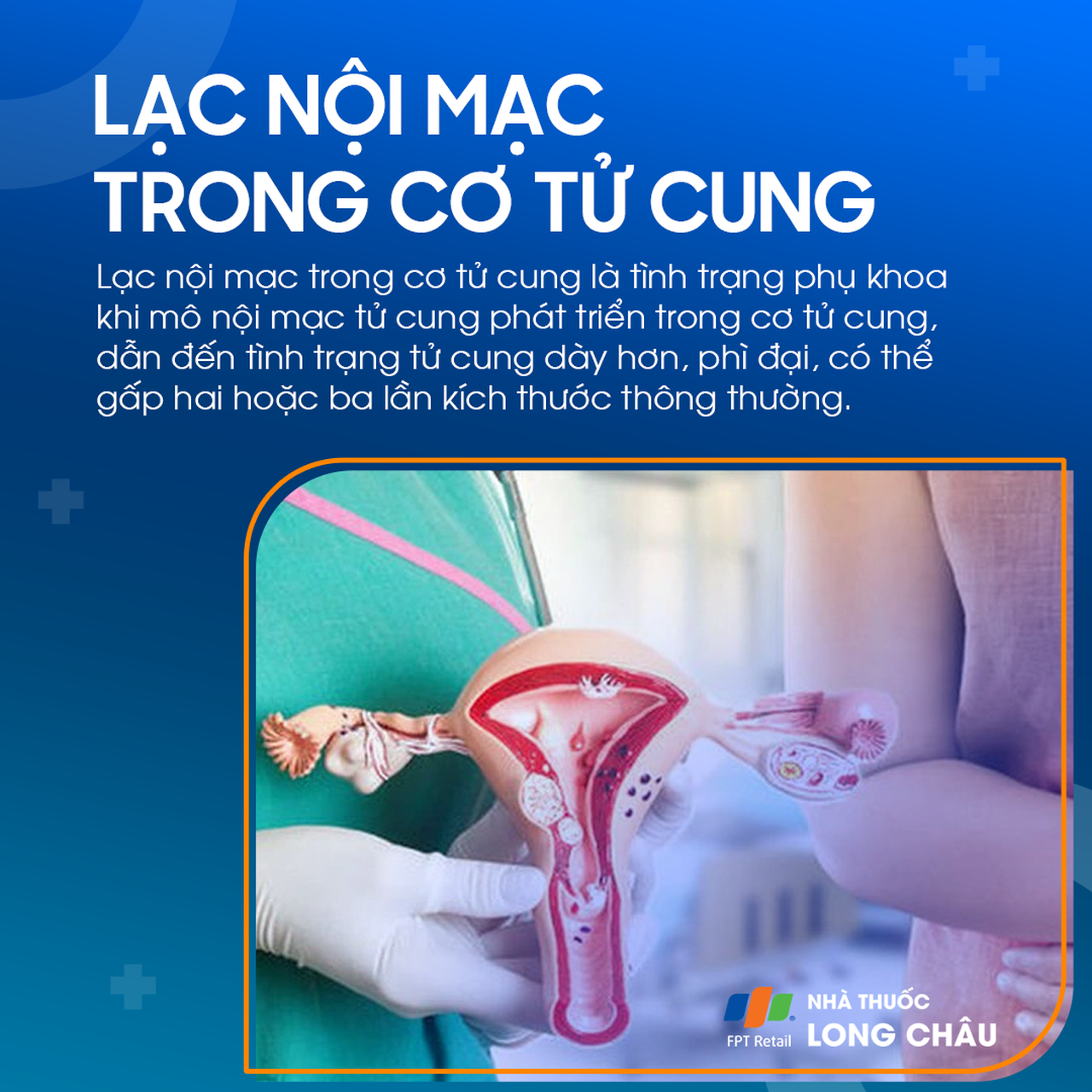 Lạc nội mạc trong cơ tử cung 1
