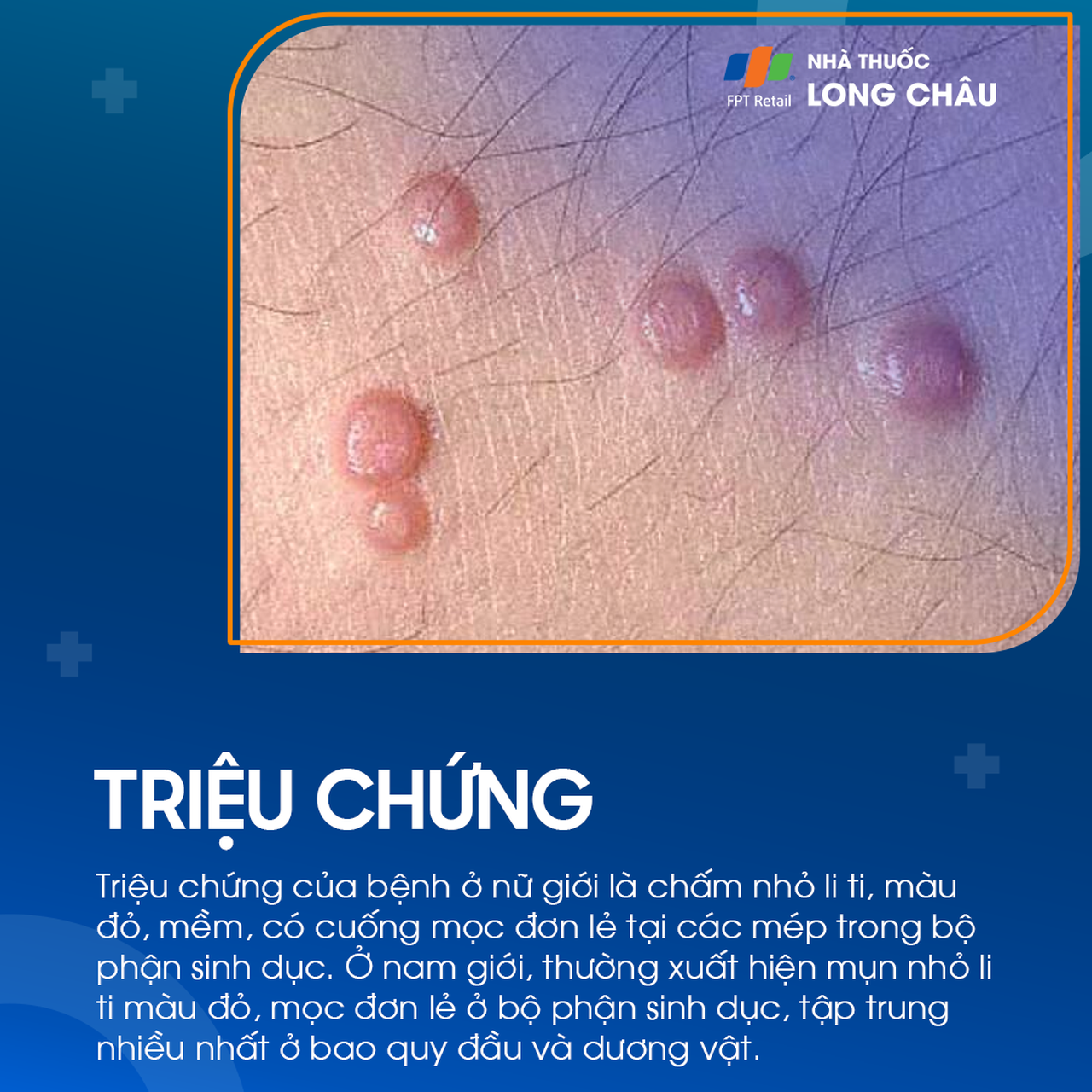 triệu chứng mụn cóc sinh dục ở người, biểu hiện qua các nốt sần hình bông cải trên da