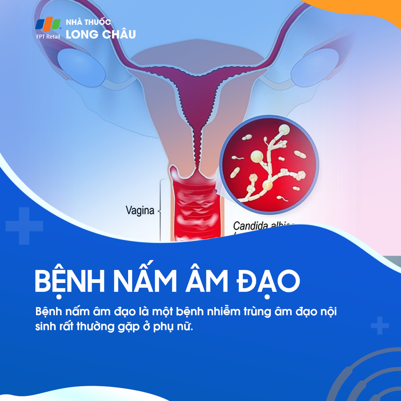 Nấm âm đạo 1