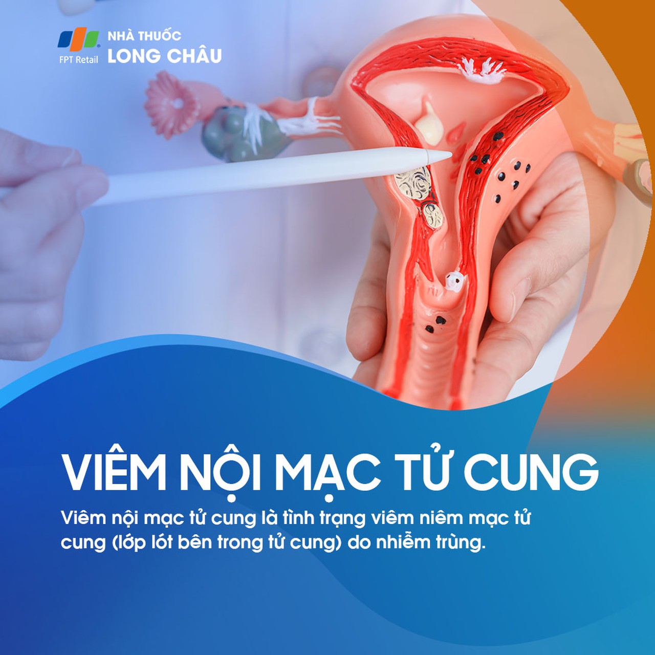 Viêm nội mạc tử cung 1