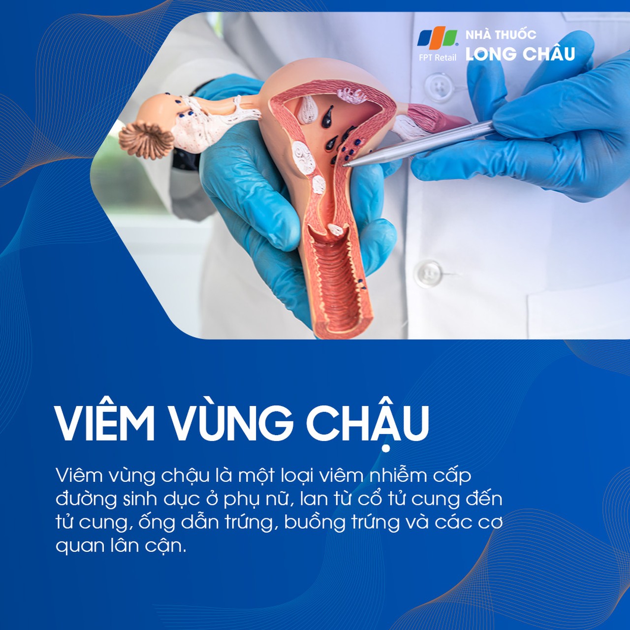 Viêm vùng chậu 1