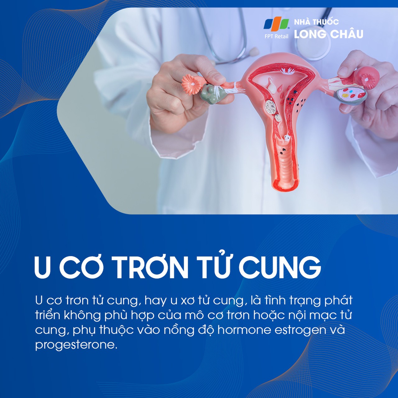 U cơ trơn tử cung 1