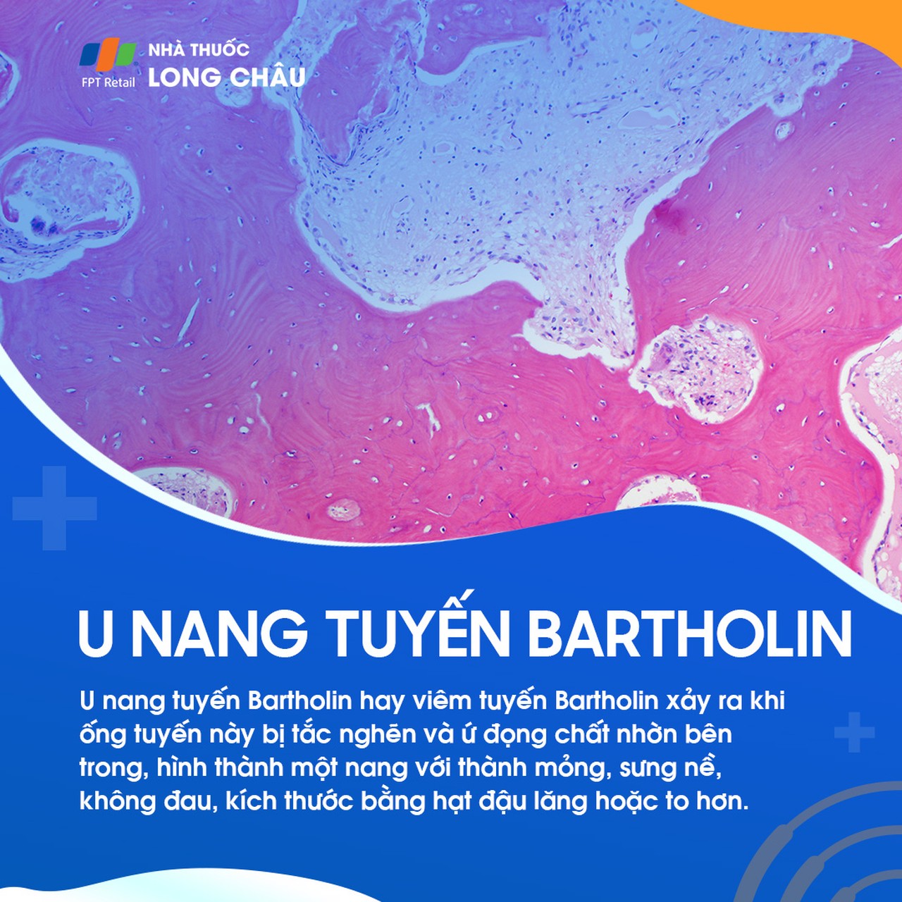 U nang tuyến Bartholin 1