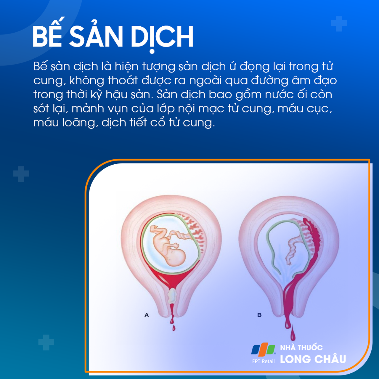 Bế sản dịch sau sinh 1