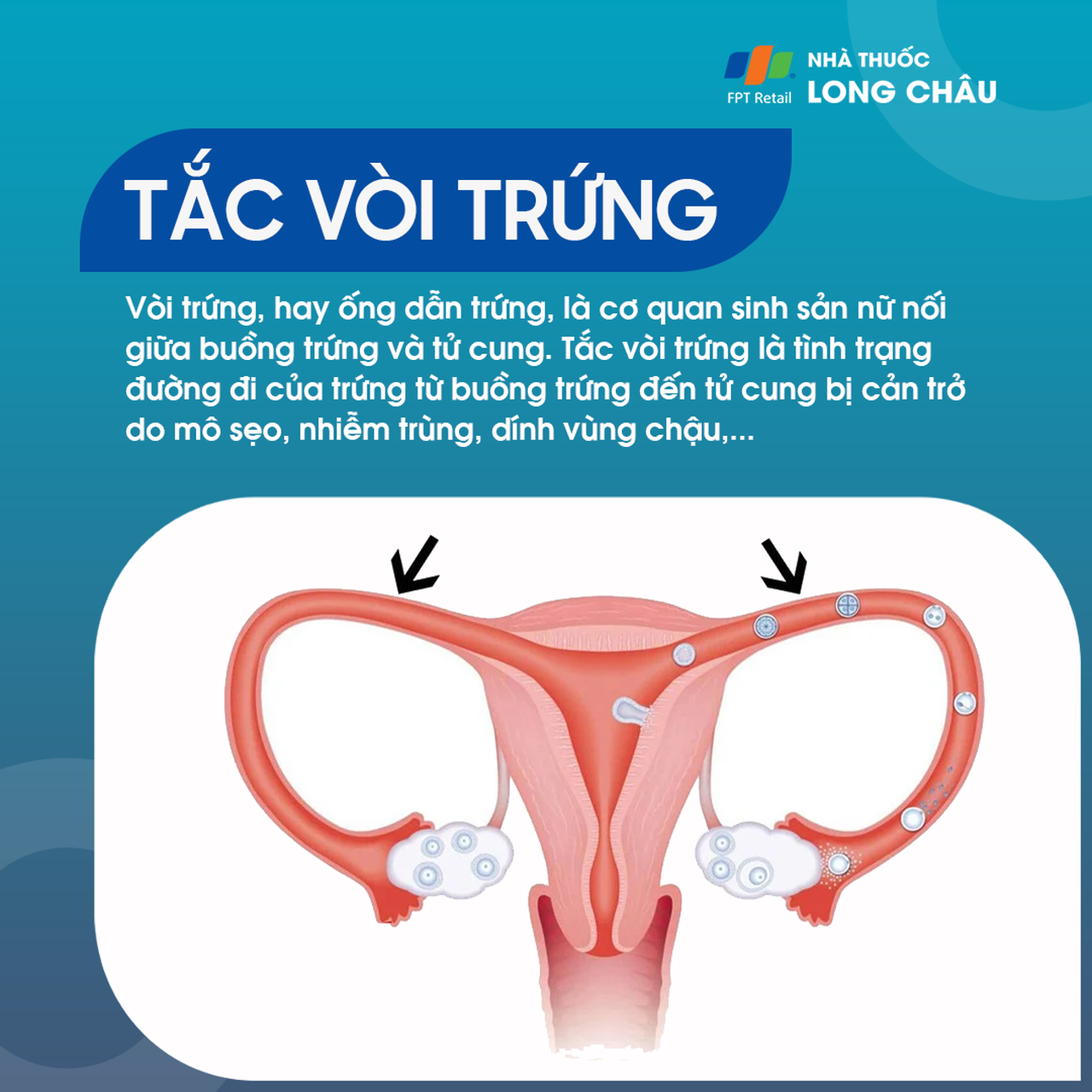 Tắc vòi trứng 1