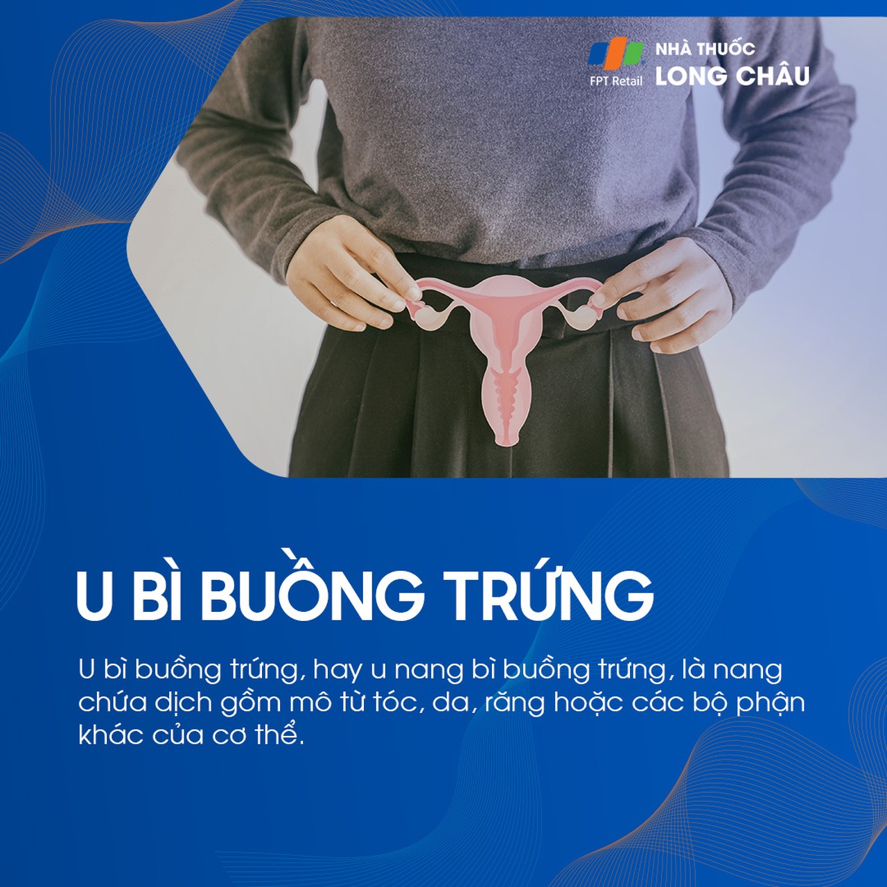 U bì buồng trứng 1