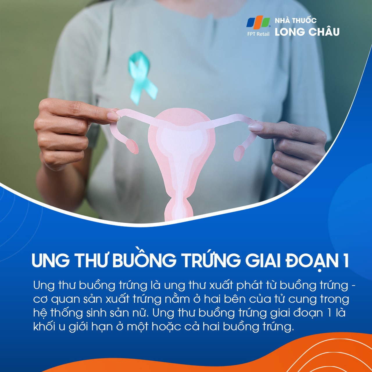 Ung thư buồng trứng giai đoạn 1 - 1