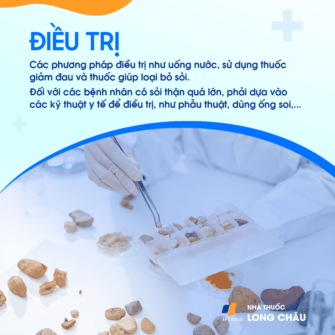Điều trị sỏi thận - Phương pháp tán sỏi và phẫu thuật loại bỏ sỏi thận