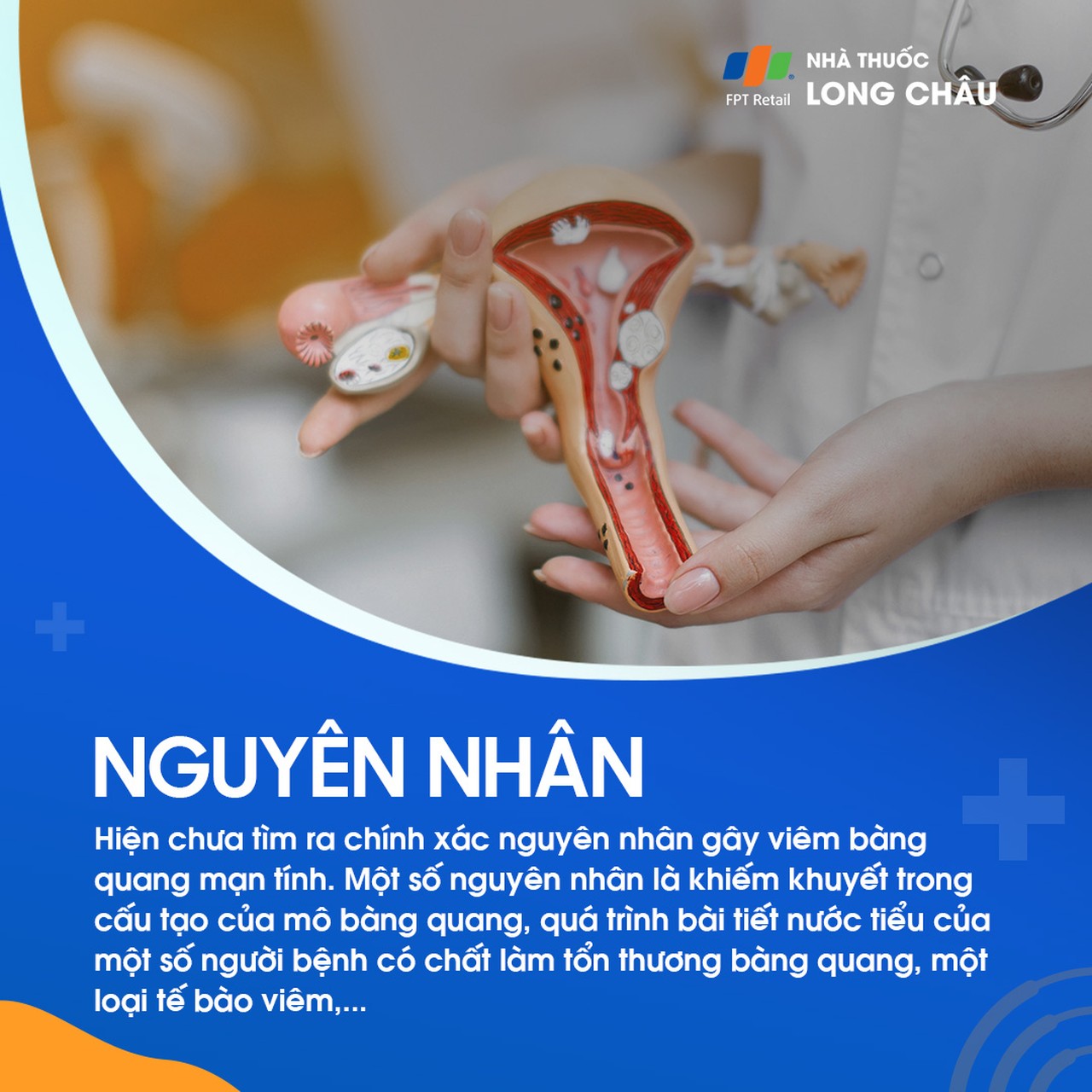 Viêm bàng quang mạn tính 3