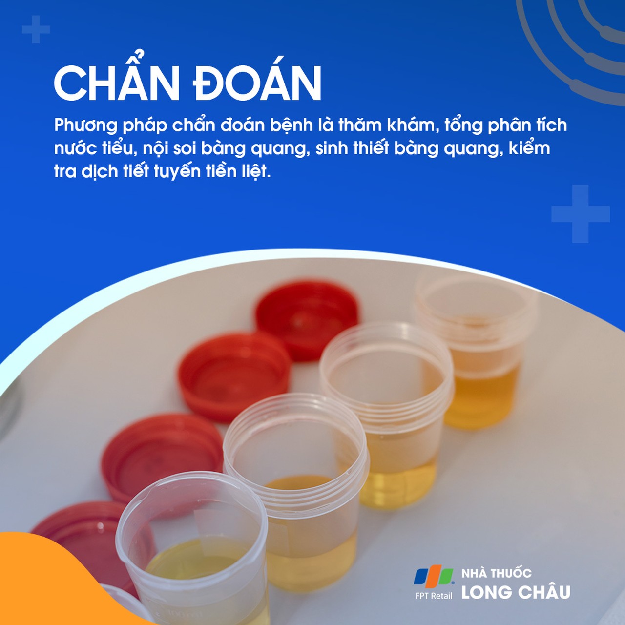 Viêm bàng quang mạn tính 5