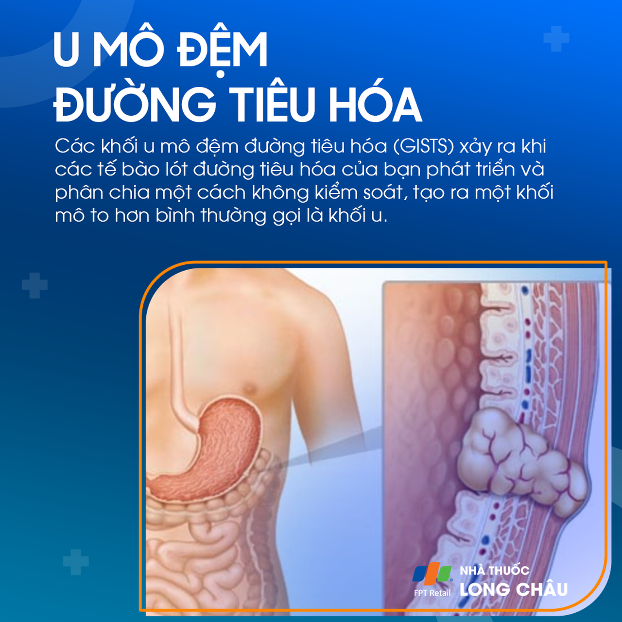U mô đệm tiêu hóa 1