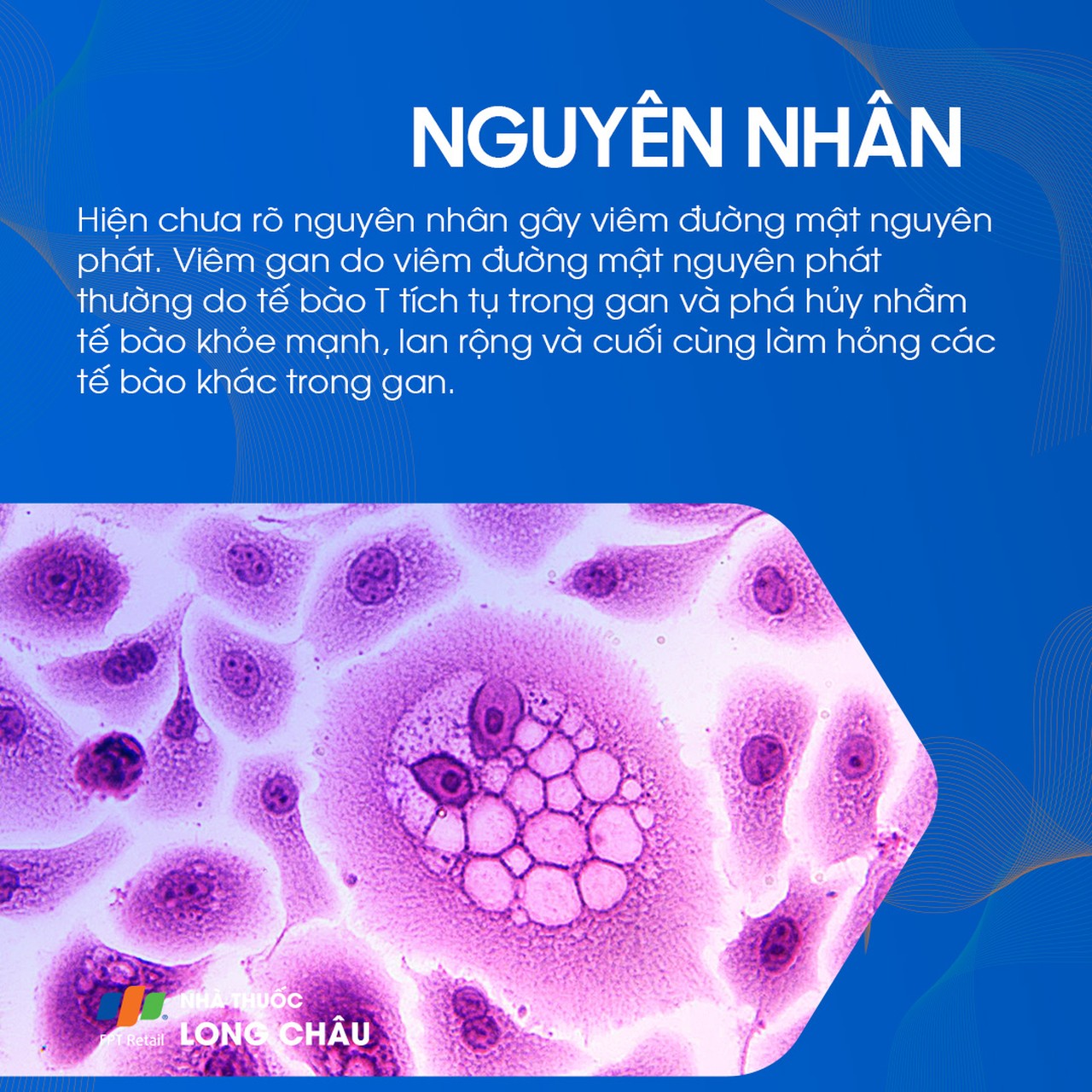 Viêm đường mật nguyên phát 3