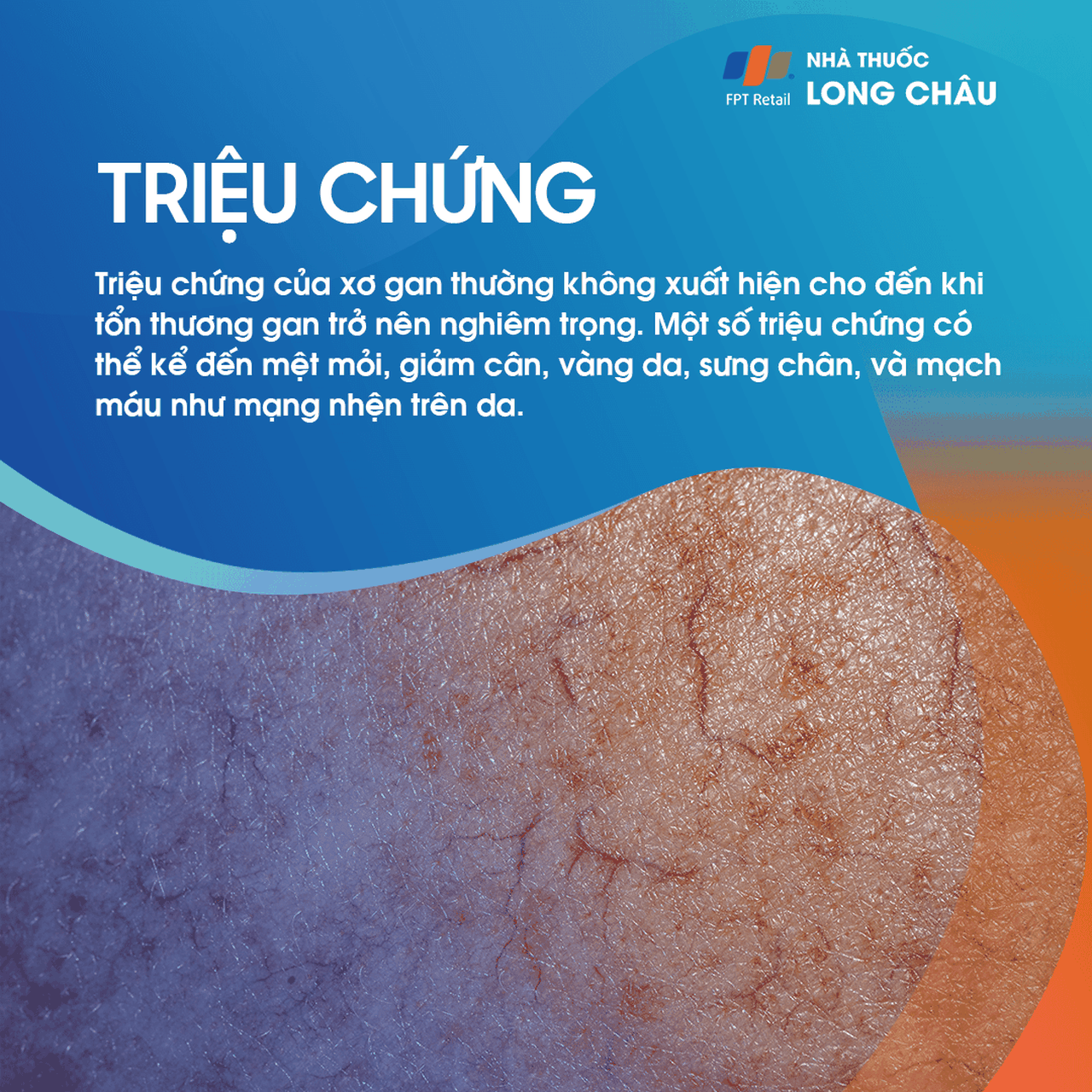 Triệu chứng xơ gan - Dấu hiệu mệt mỏi và vàng da do tổn thương gan mãn tính