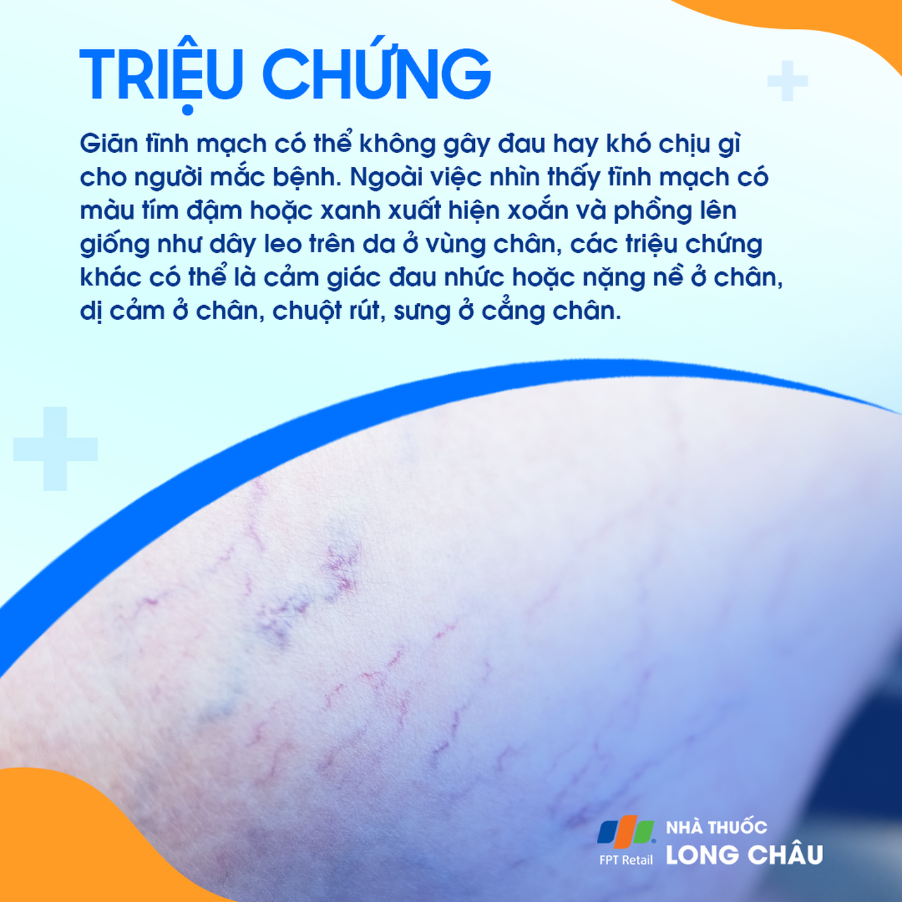 Giãn tĩnh mạch 2