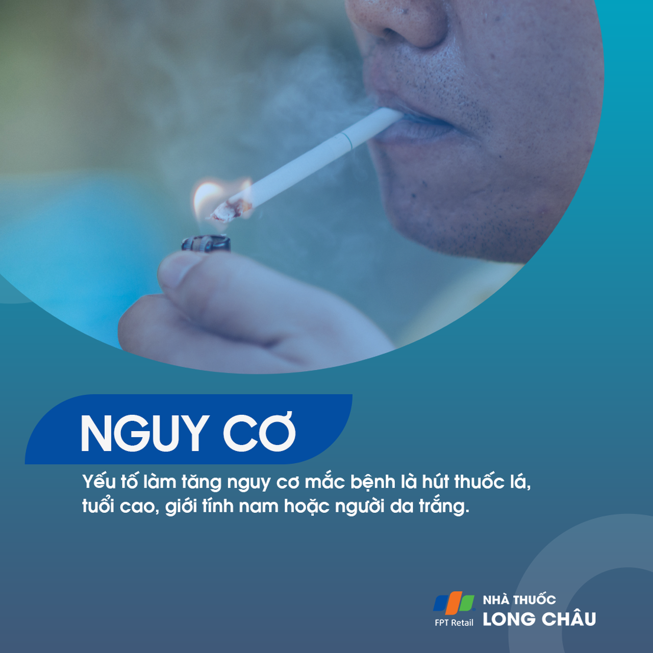 Phình động mạch chủ bụng 4