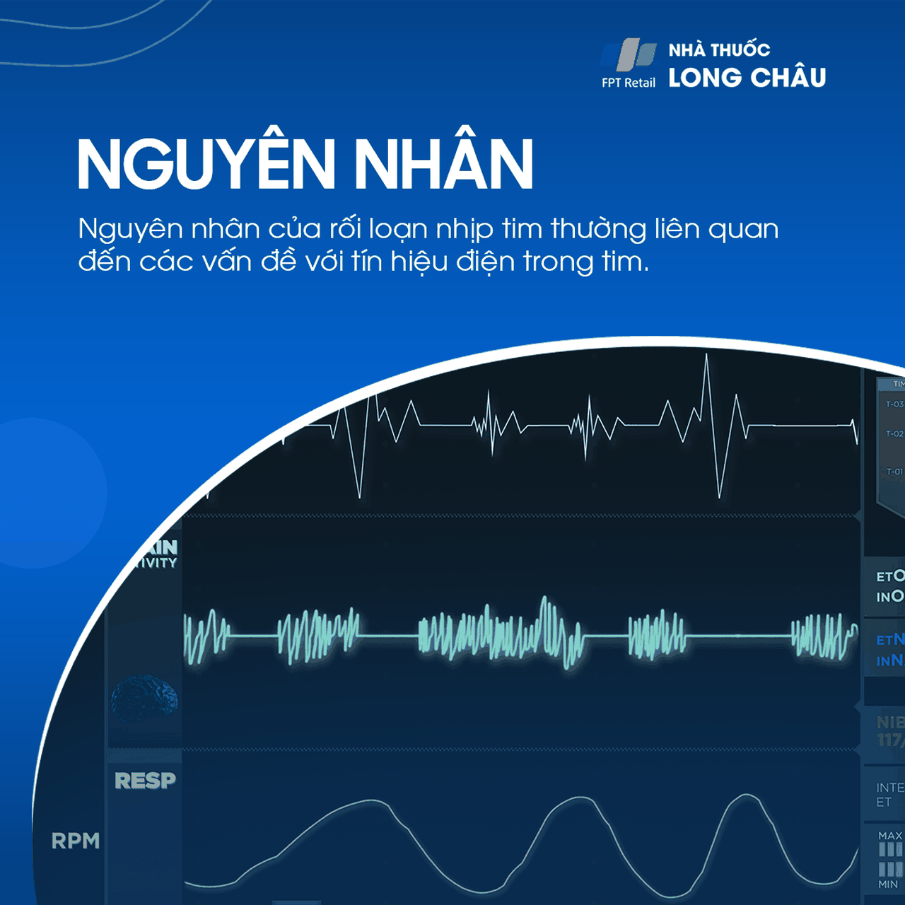 Nguyên nhân rối loạn nhịp tim do bệnh tim mạch, stress và rối loạn điện giải
