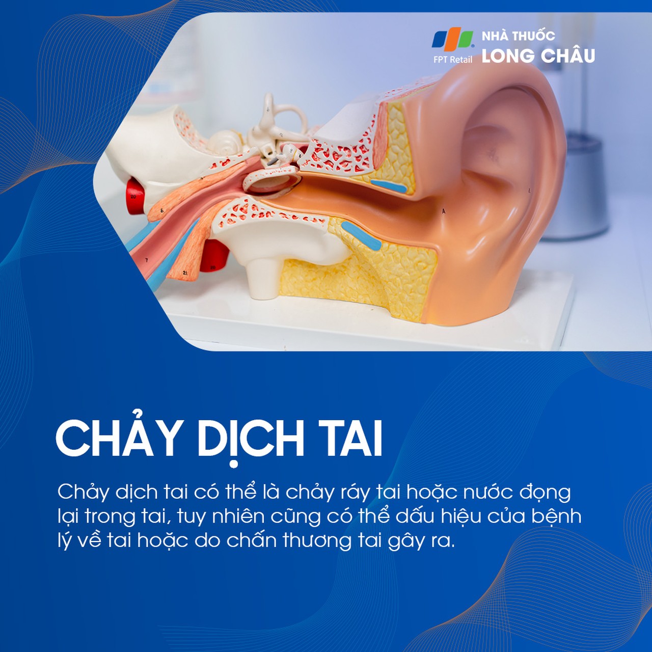 Chảy dịch tai có thể do ráy tai, nước đọng, hoặc là dấu hiệu bệnh lý – chấn thương tai