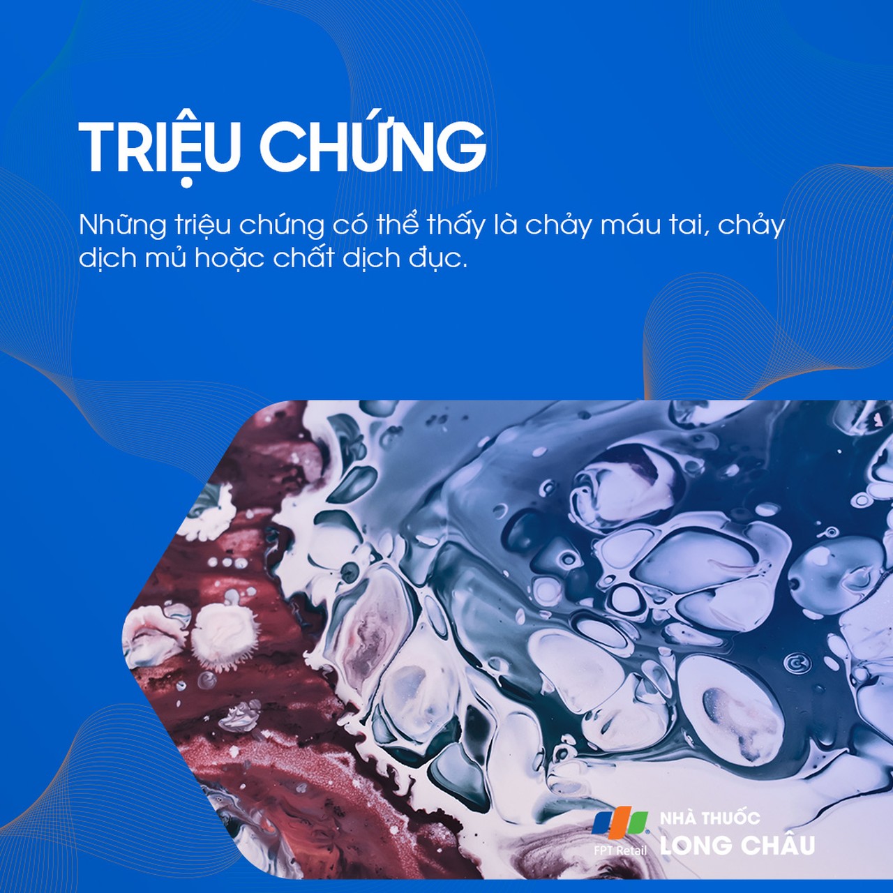 Có thể thấy dịch mủ, máu tai, hoặc dịch nhầy bất thường chảy ra từ tai