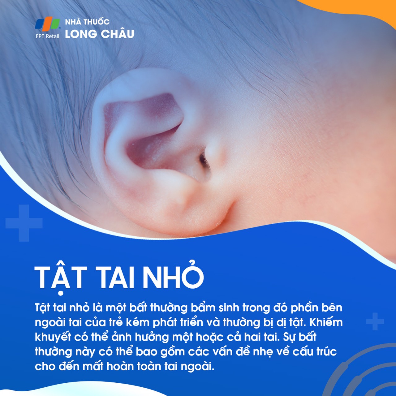 Tật tai nhỏ 1