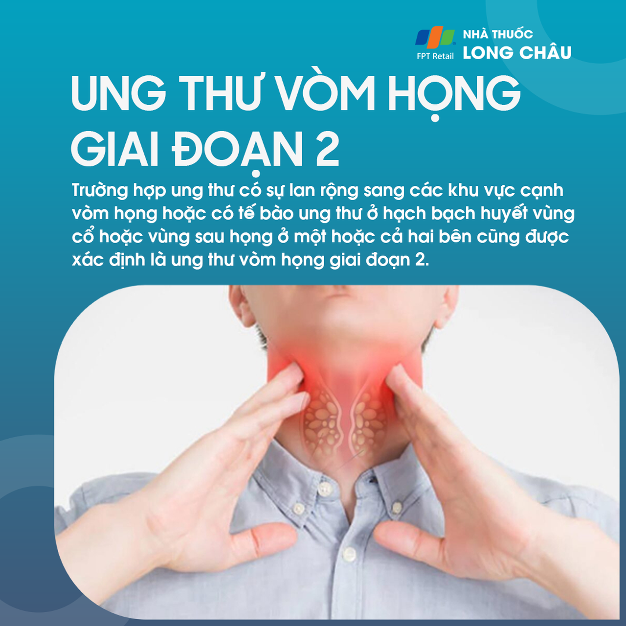 Ung thư vòm họng giai đoạn 2 - 2