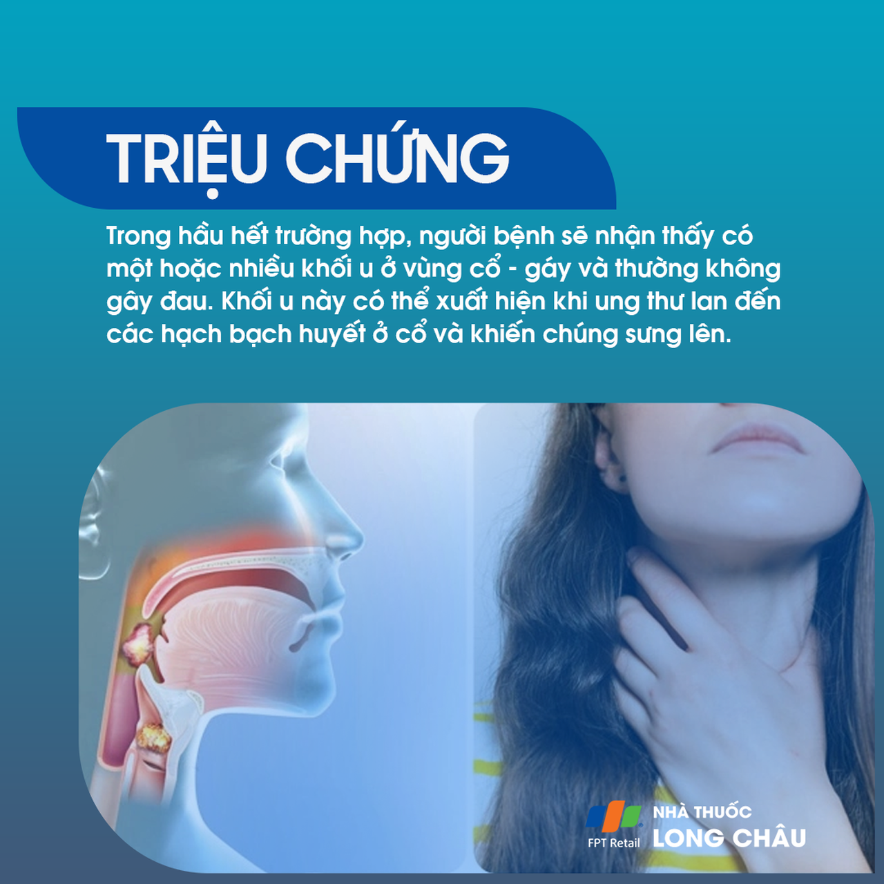 Ung thư vòm họng giai đoạn 2 -3