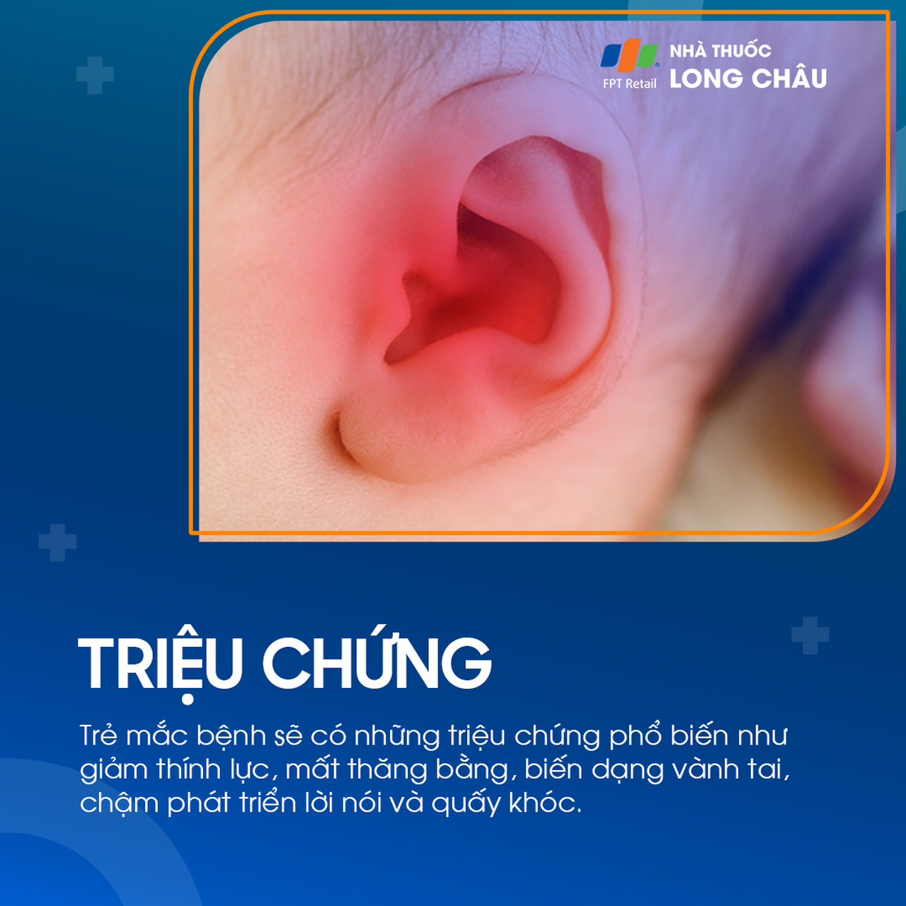 Viêm tai giữa ứ dịch 2