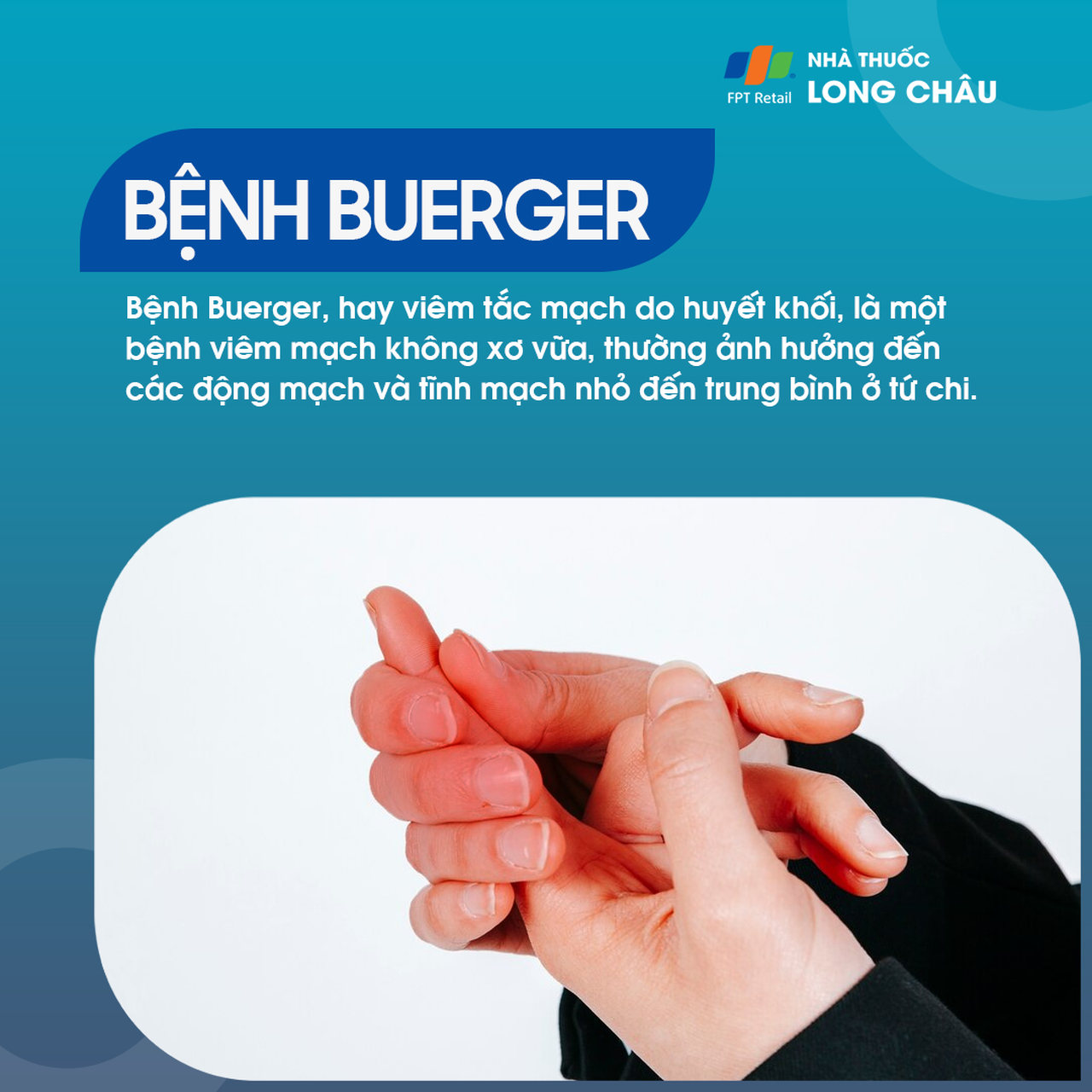 Bệnh Buerger 1