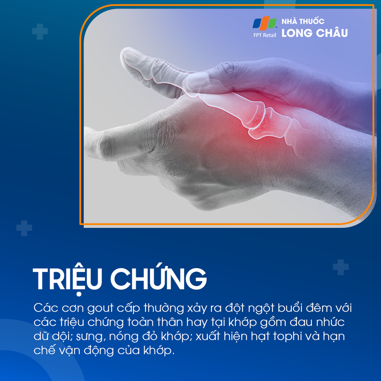 Gout cấp tính 2