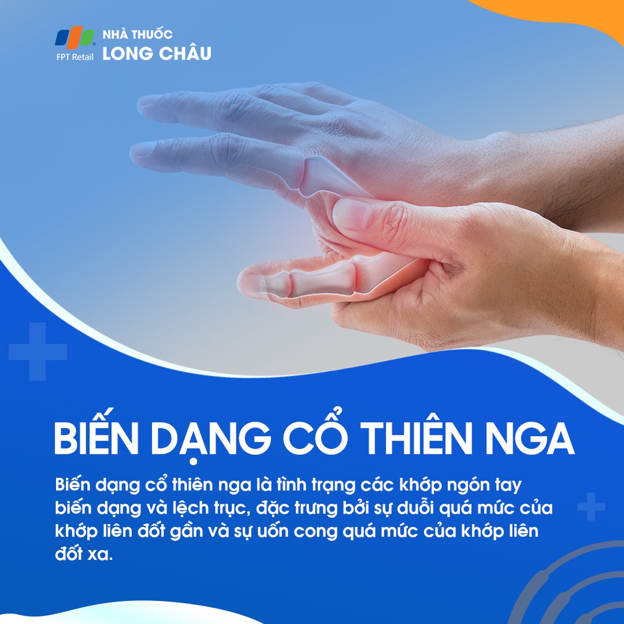 Biến dạng cổ thiên nga là tình trạng ngón tay cong bất thường, giống hình cổ thiên nga