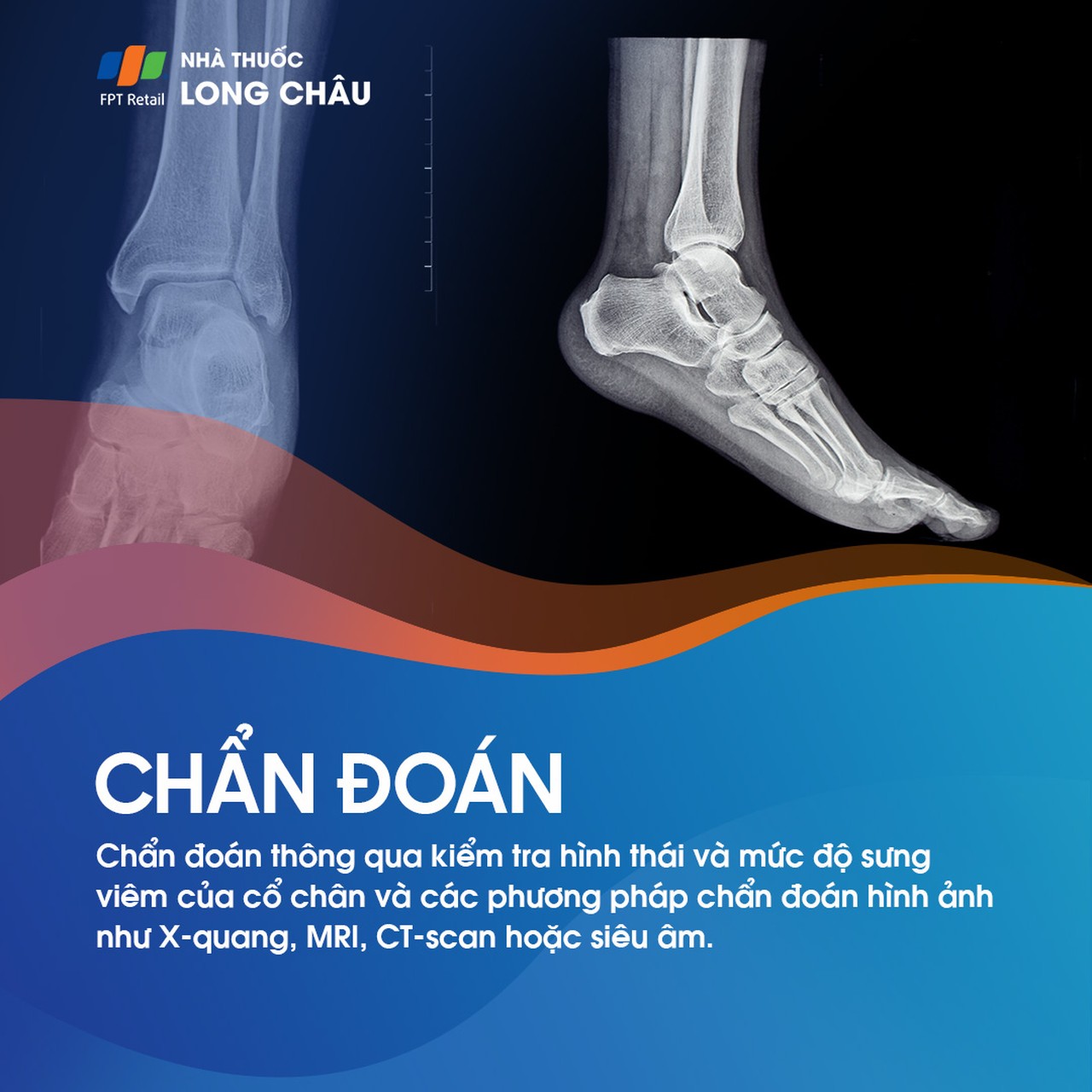 Bong gân cổ chân 5