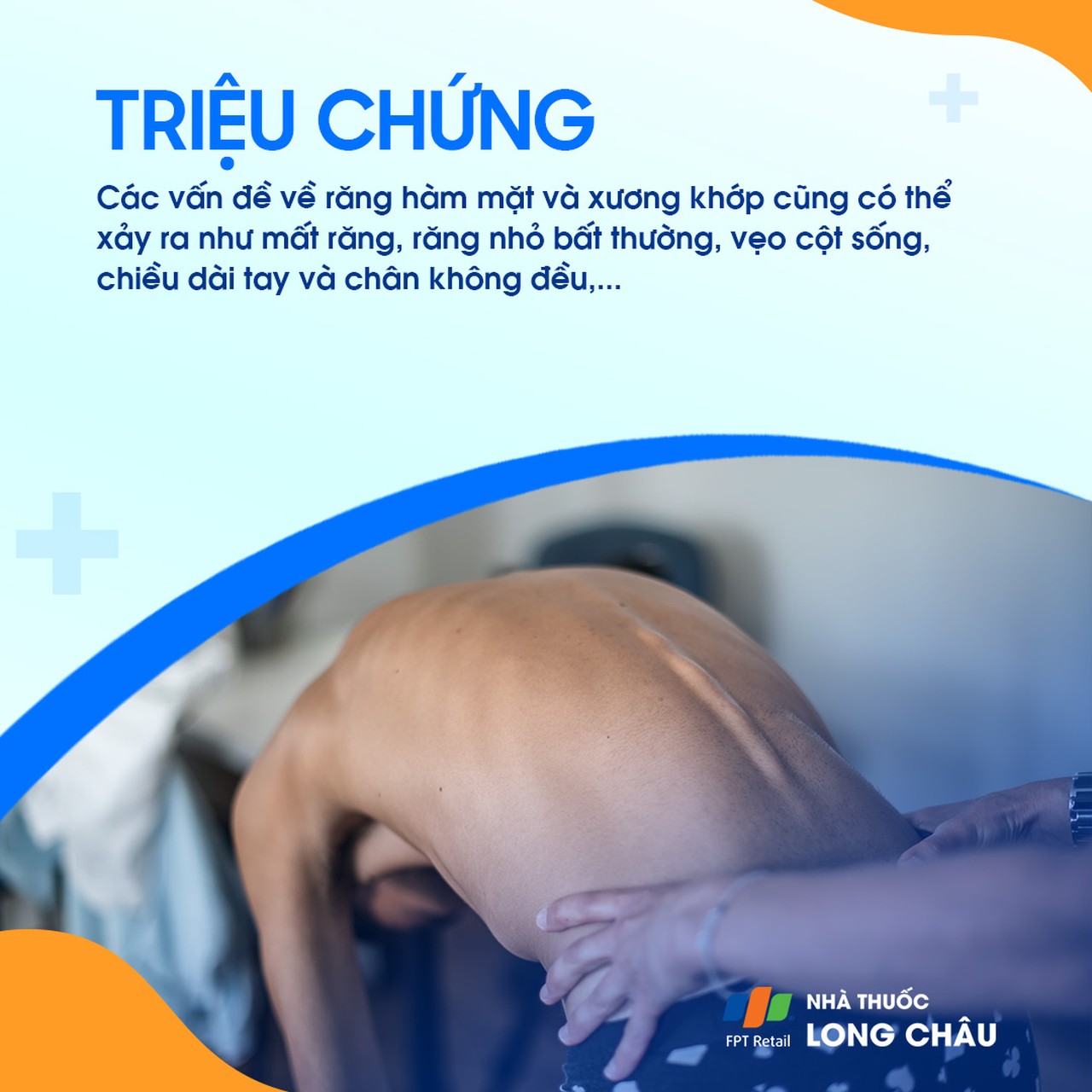 Hội chứng Silver - Russell 3