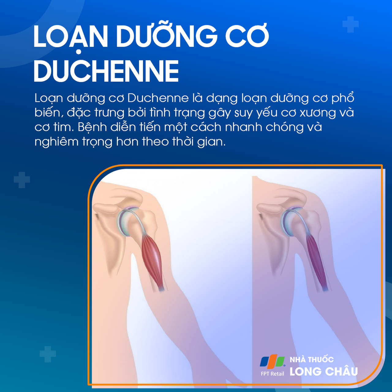 Loạn dưỡng cơ Duchenne 1