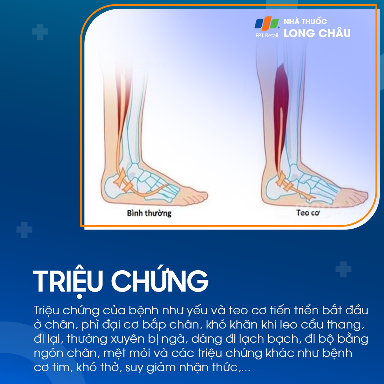Loạn dưỡng cơ Duchenne 2