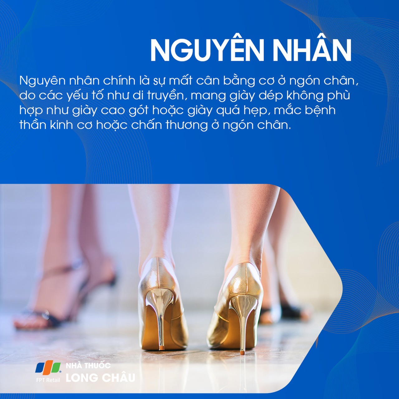 Ngón chân hình búa 3