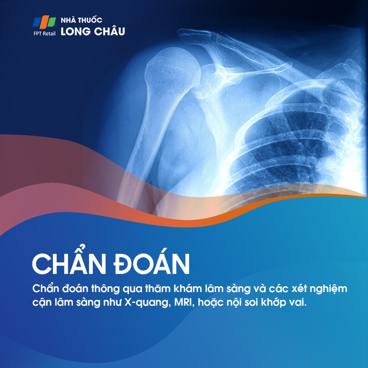 Rách sụn viền khớp vai 5