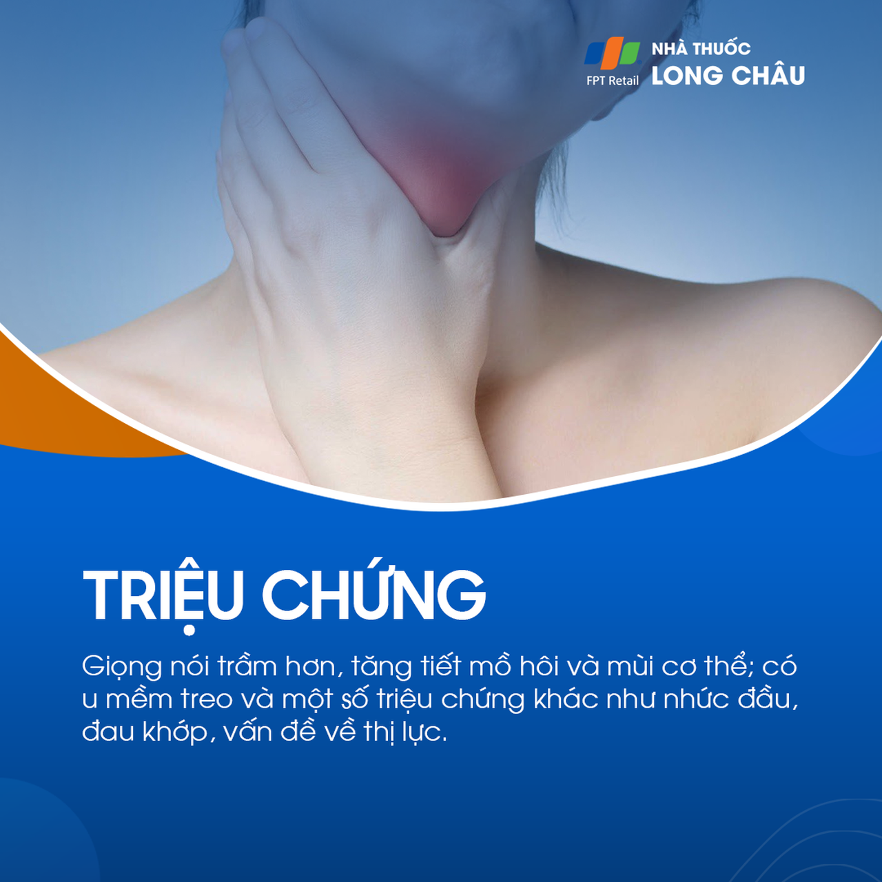 Bệnh to các viễn cực 3