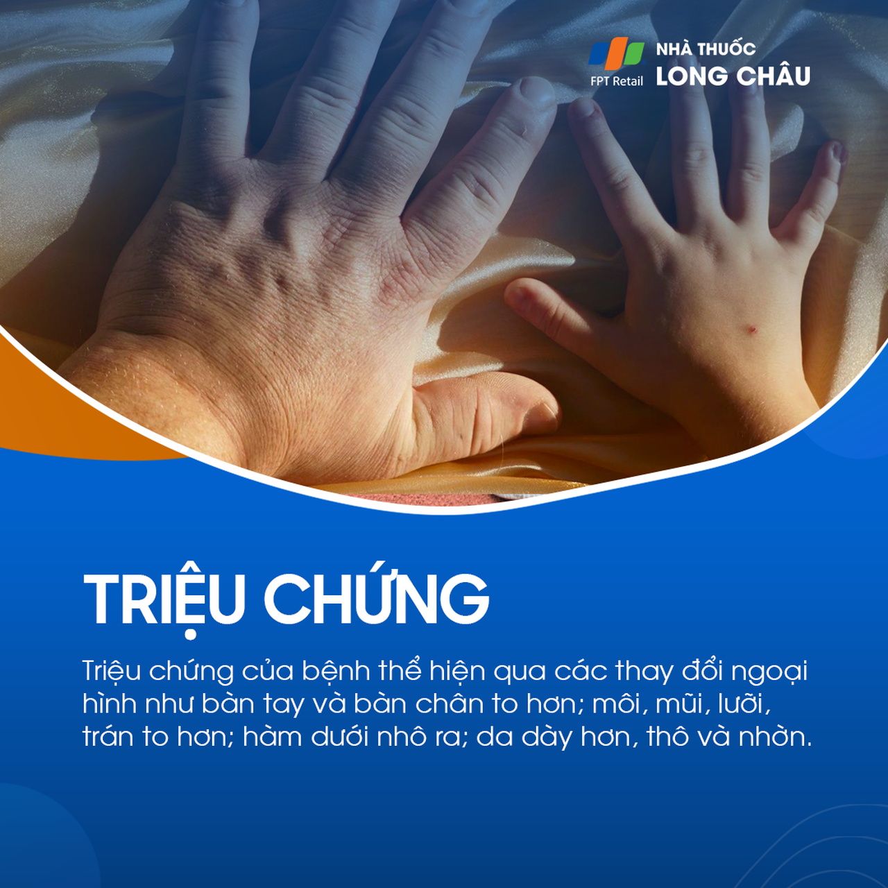 Bệnh to các viễn cực 2