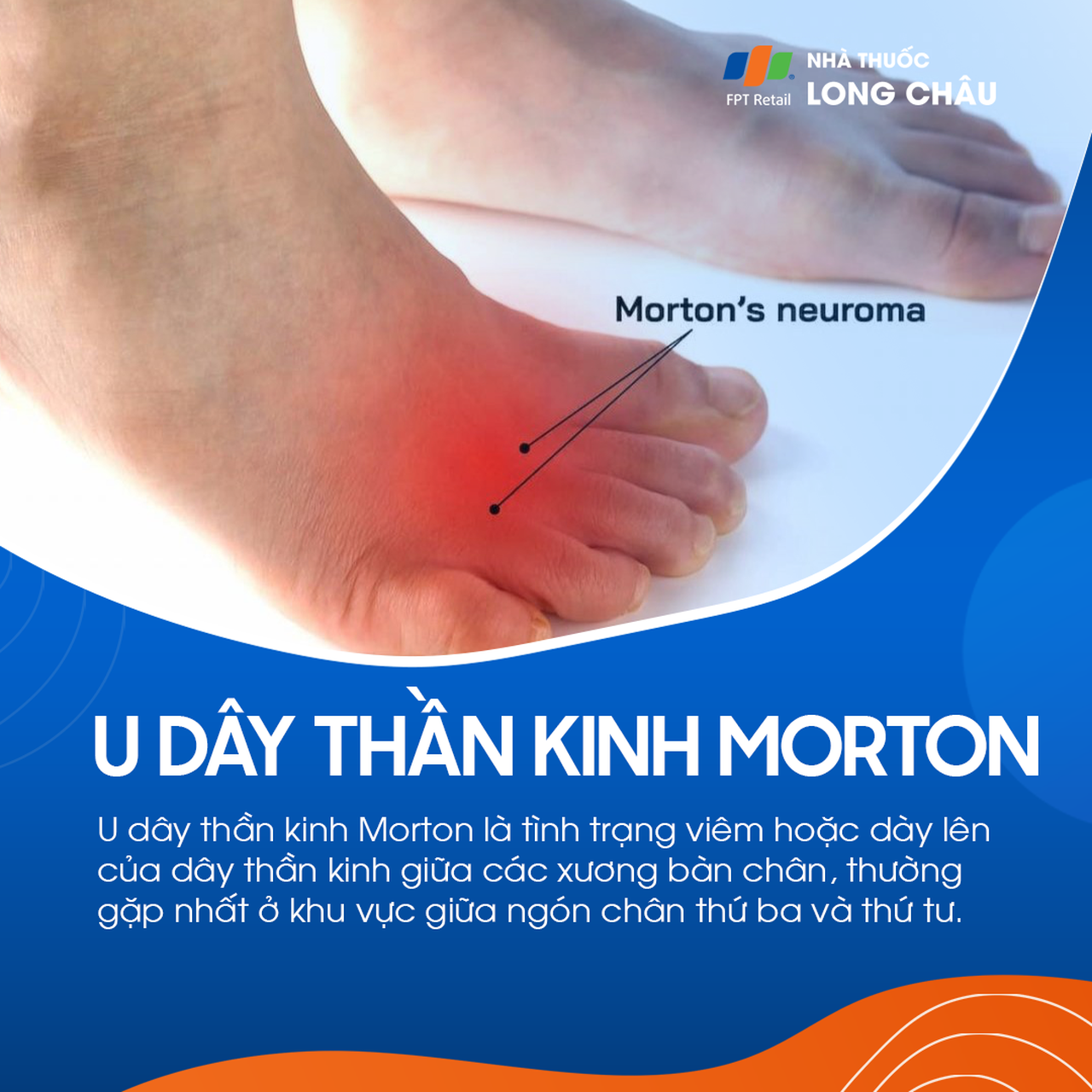 U dây thần kinh morton 