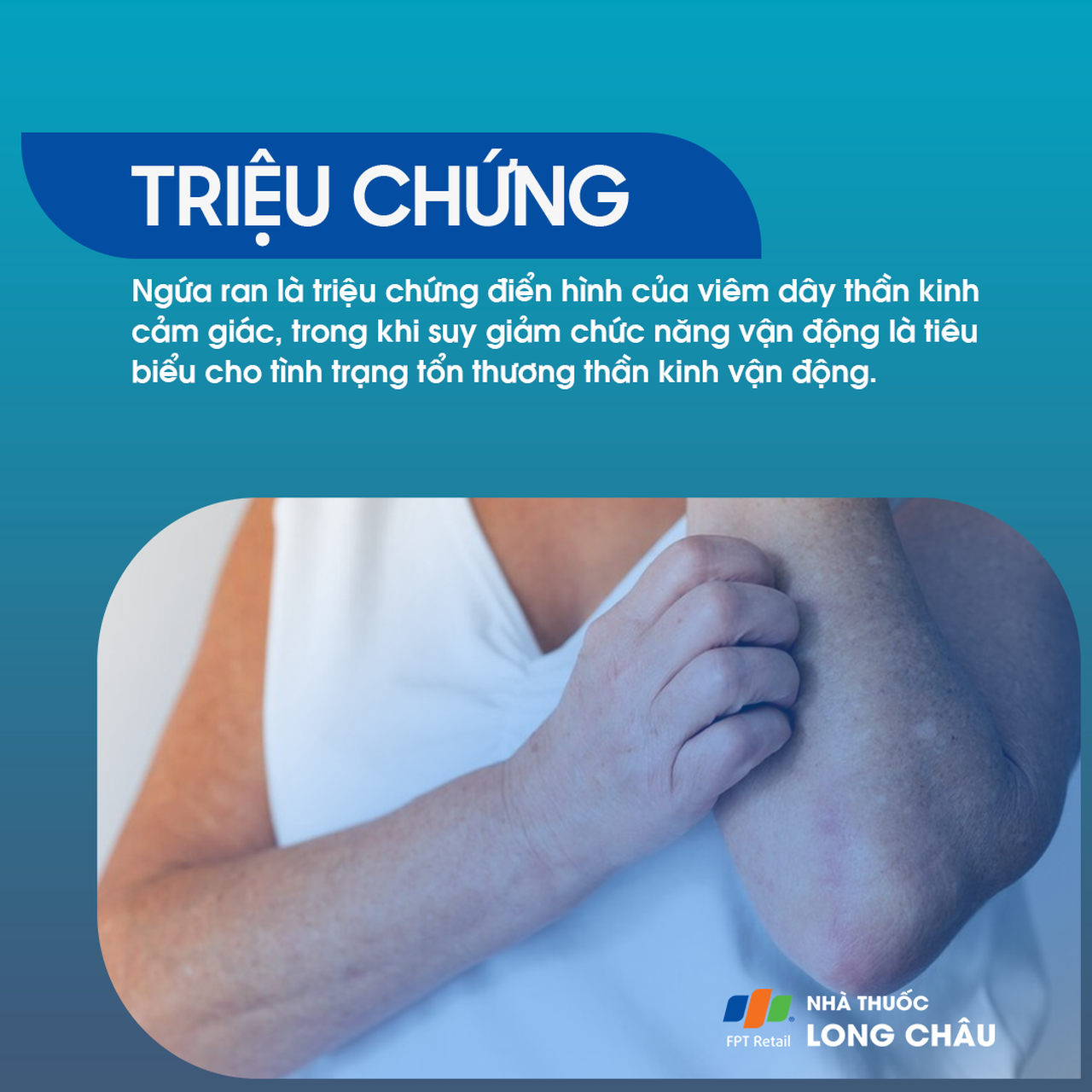 Viêm đa dây thần kinh 3