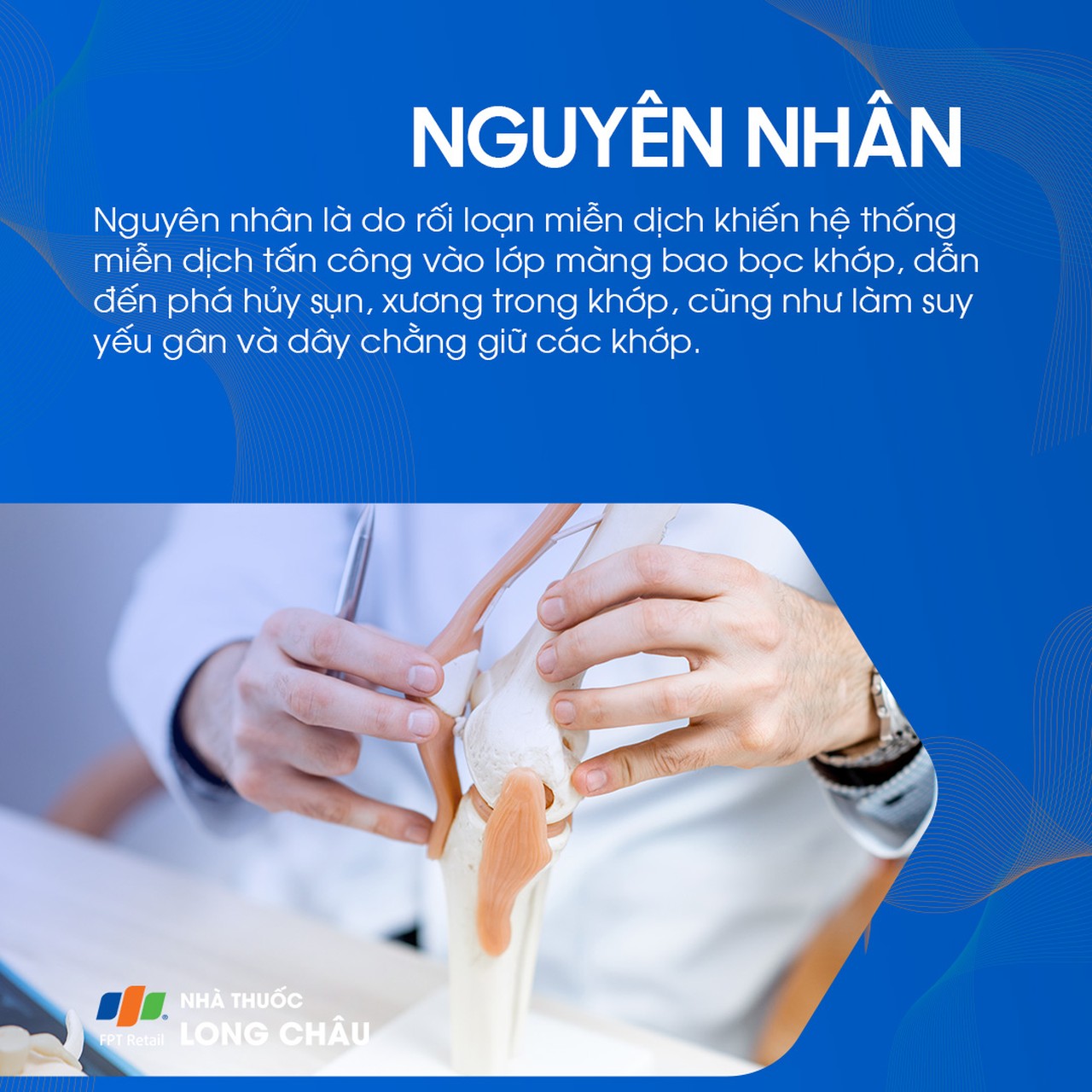 Viêm khớp dạng thấp 3